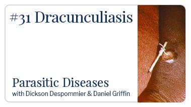 Dracunculosis