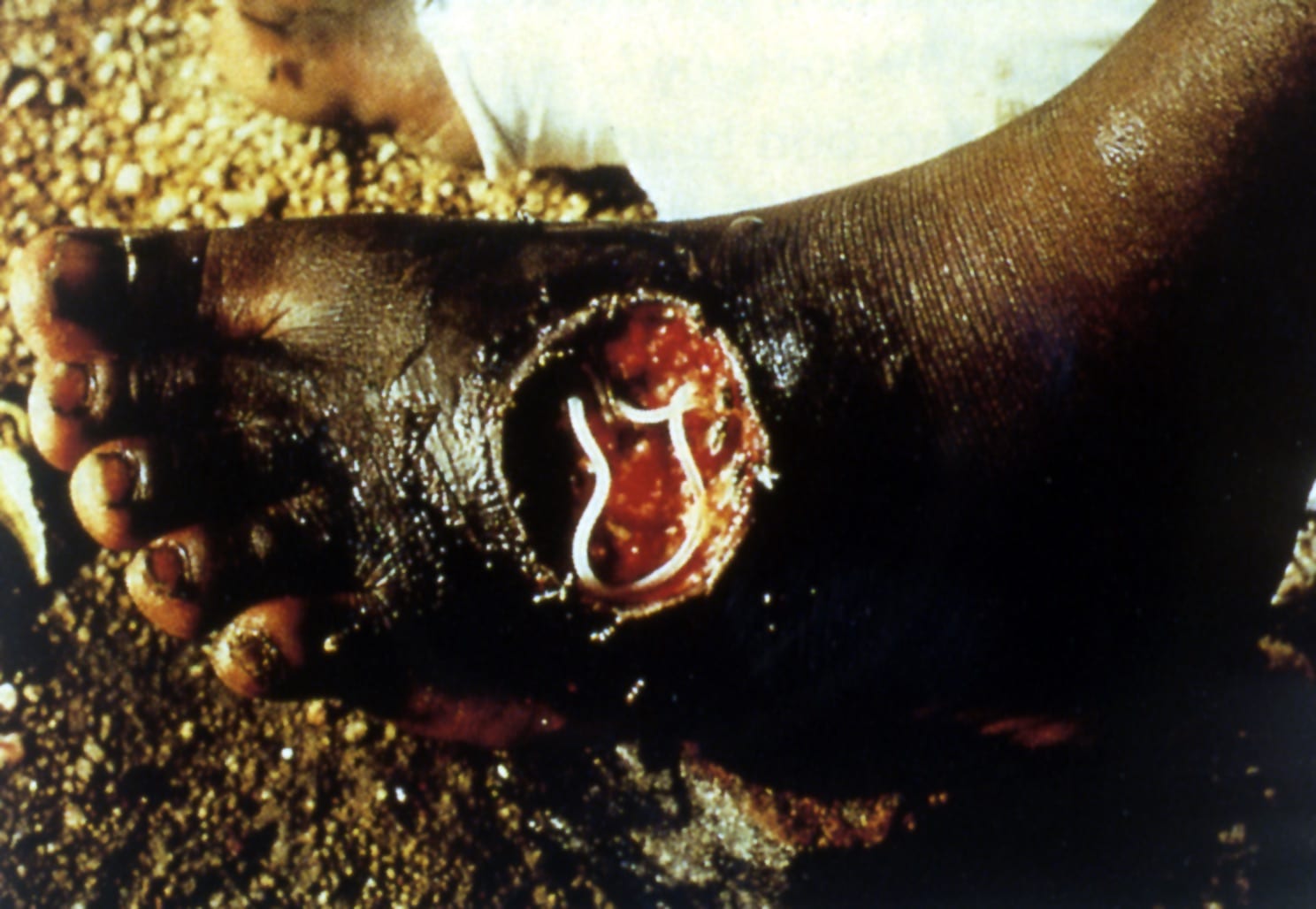 Acute case of Dracunculus medinensis.