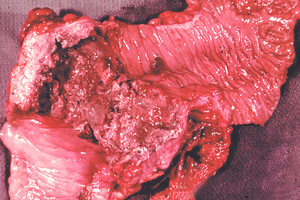 Flask-shaped ulcers due to Entamoeba histolytica. Fatal case.