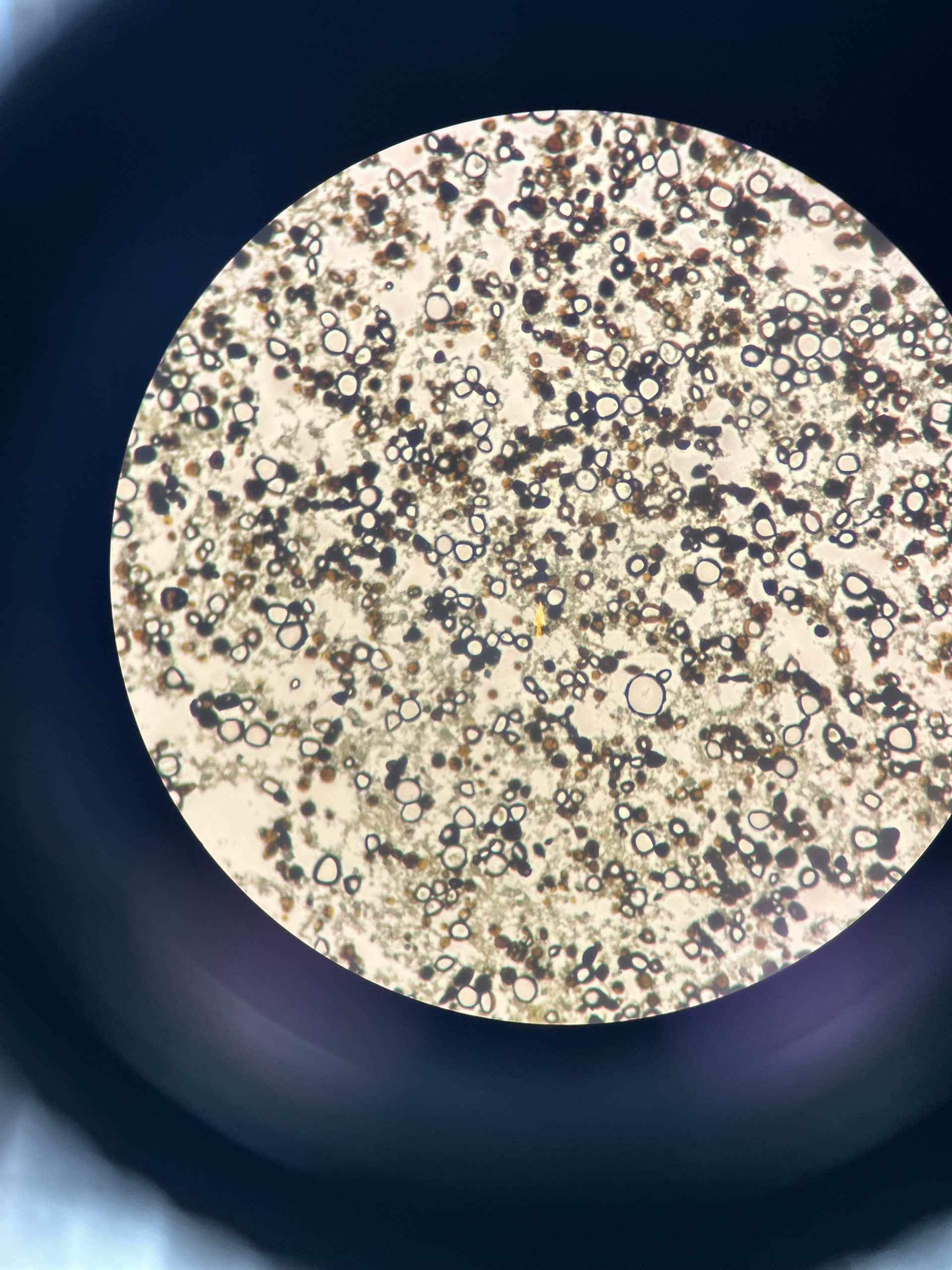 TMC. Microscopy in a sample with Paracoccidioides (provided by Melissa Parkinson, MD)