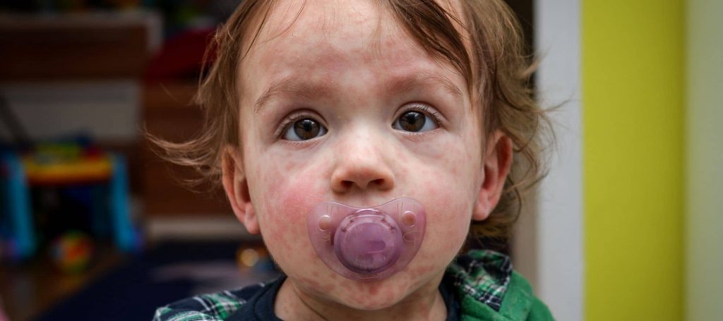 Young baby boy with pacifier in mouth and signs of measles looking at camera