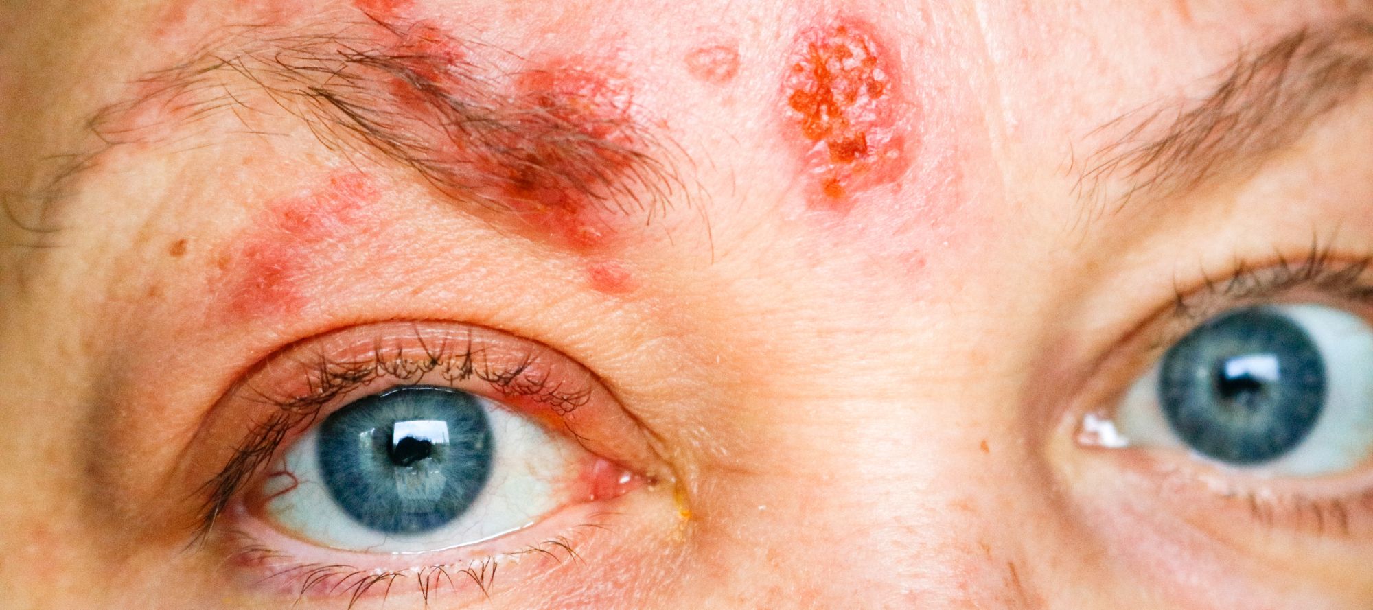 A close up shot of someone with Herpes Zoster Ophthalmicus on their face