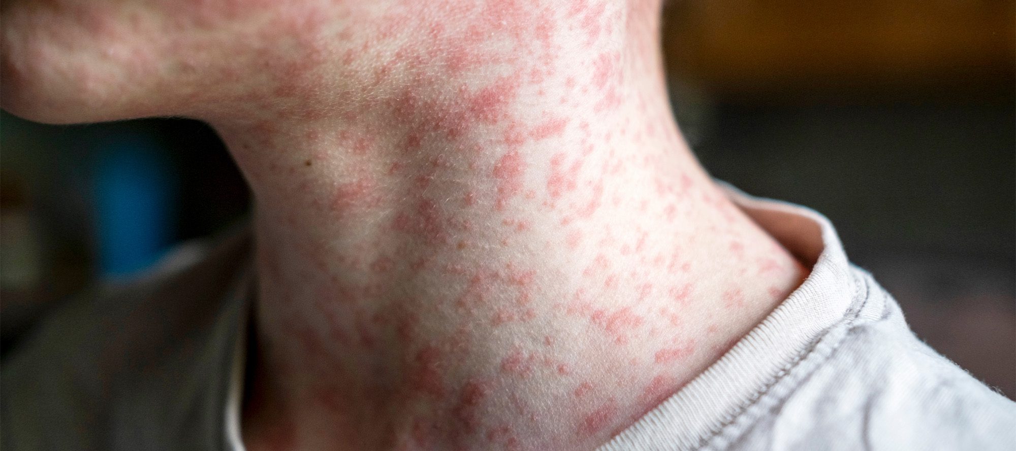 Young person showing symptoms of measles infection