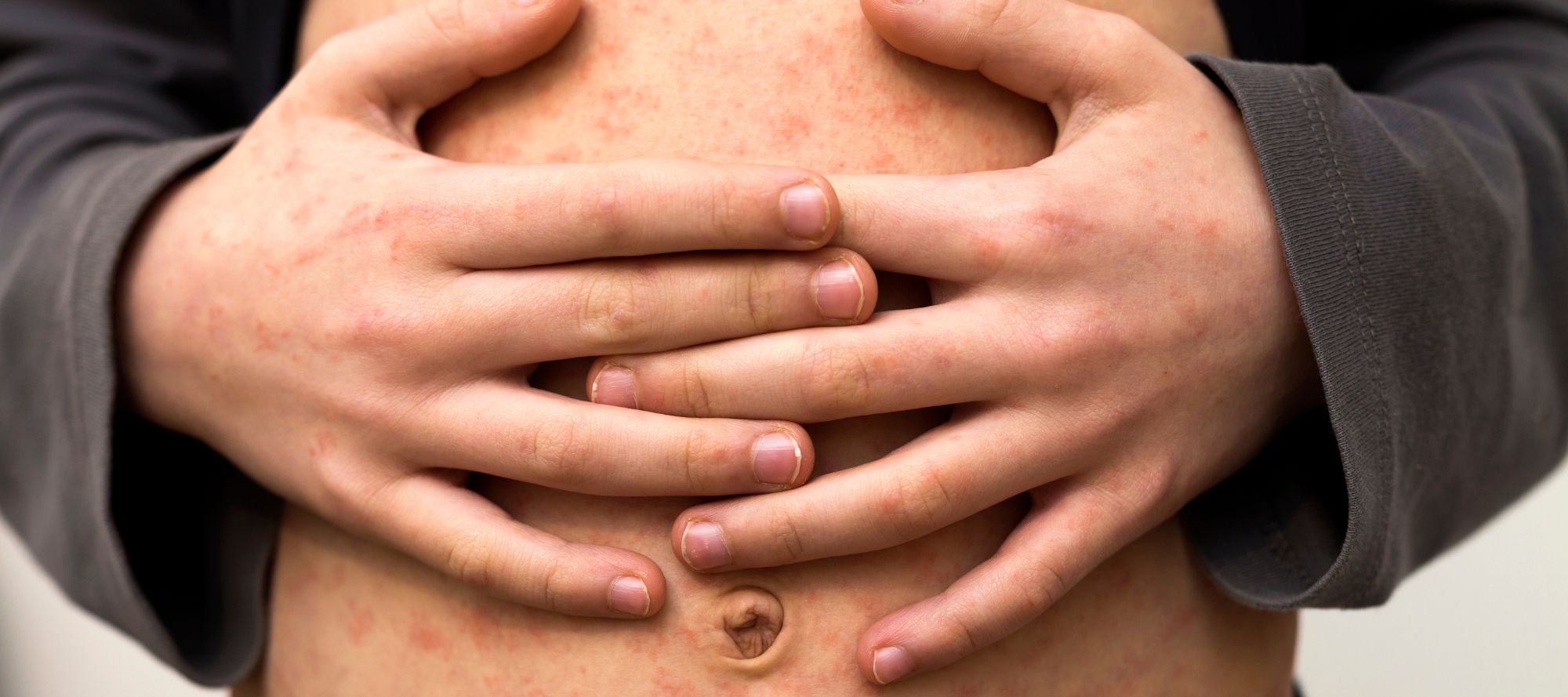 Young child holding their hands over their stomach with clear signs of measles on skin