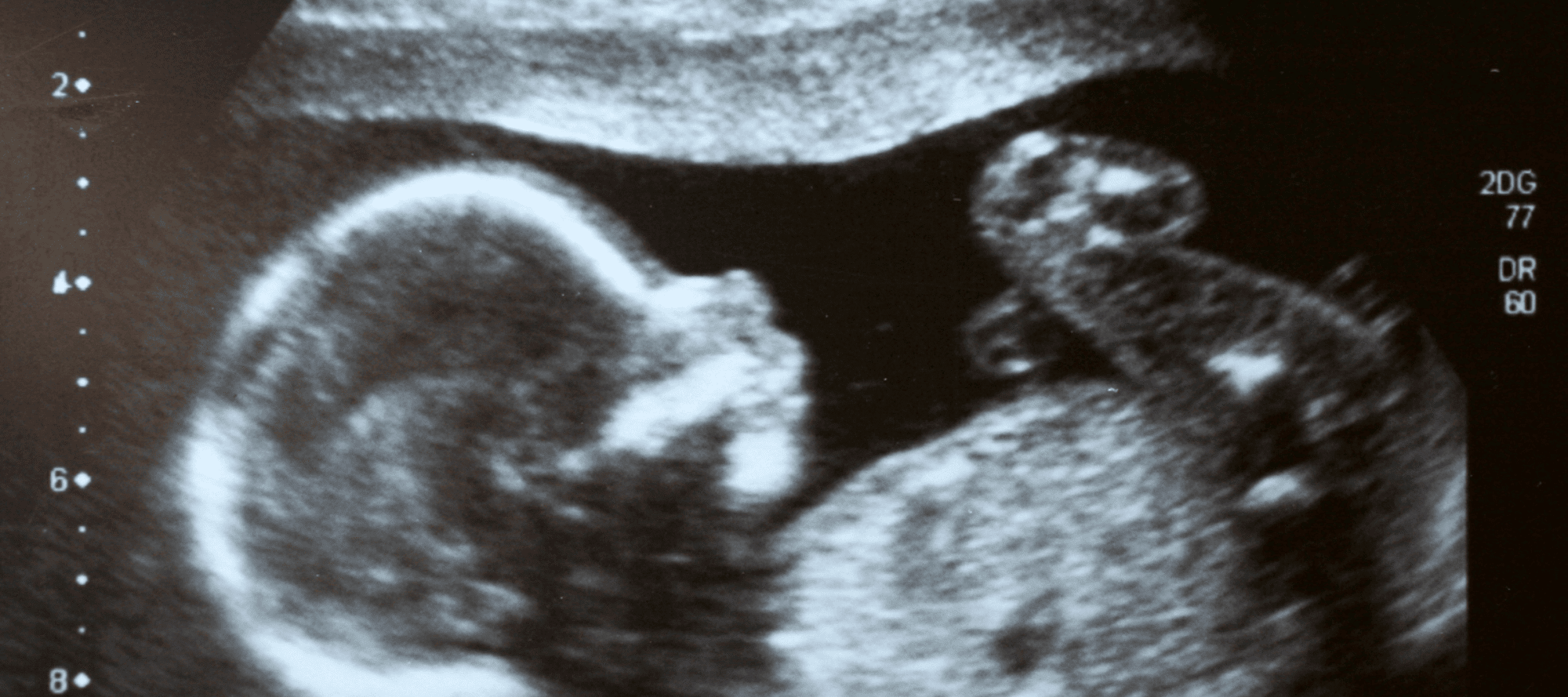 Pregnant